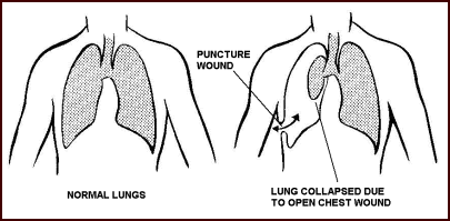 First Aid in Chest Injuries